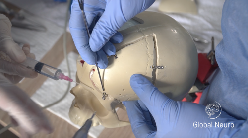 Upcoming Global Neuro Neurotrauma Course